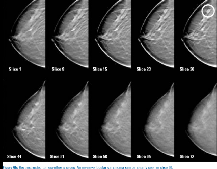 Digital Tomosynthesis 